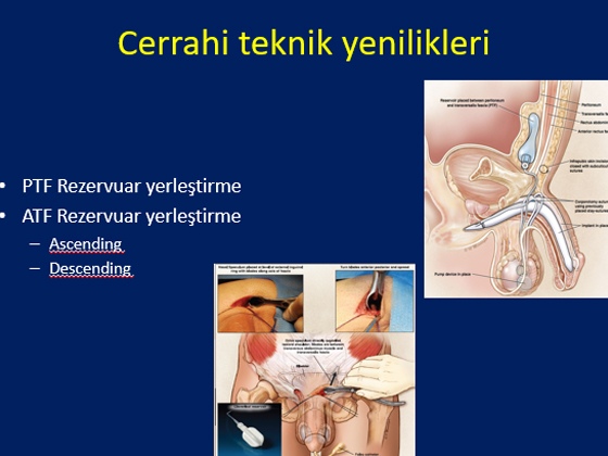 Radikal Prostatektomi Sonrası Erektil Disfonksiyon