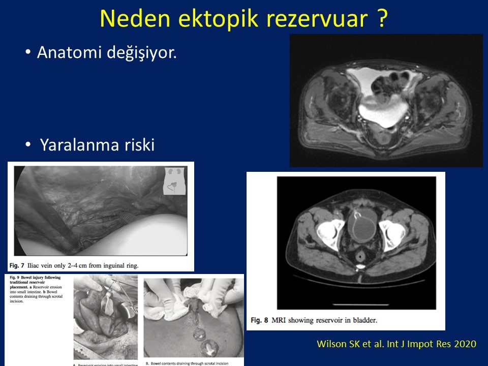 Penil Protez İmplantasyonu