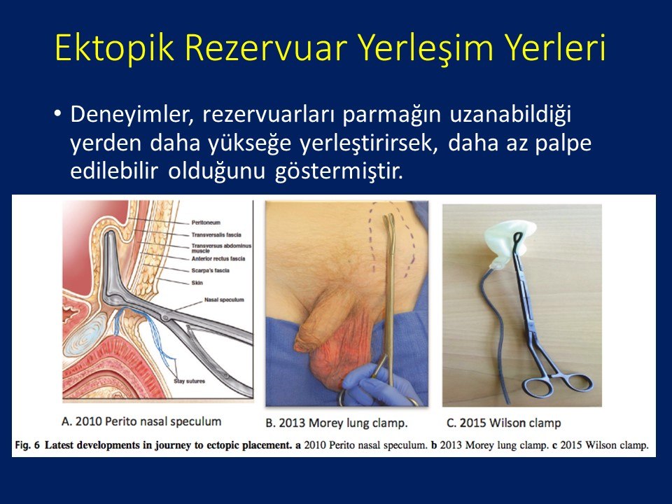 Penil Protez İmplantasyonu